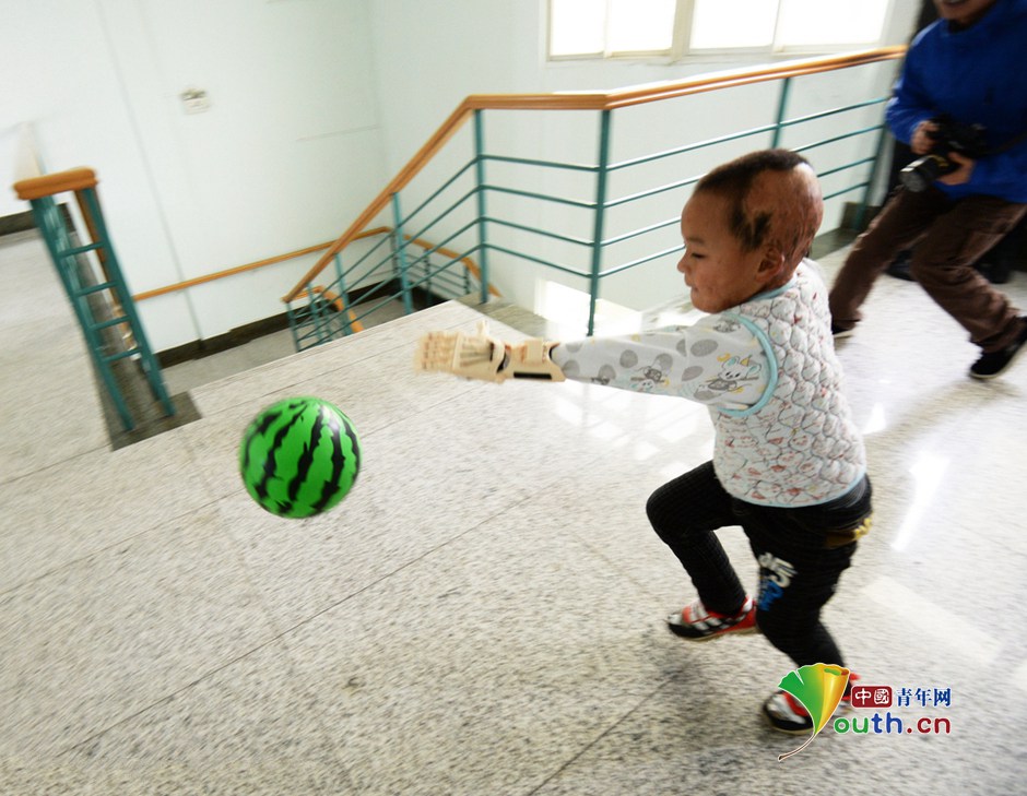 Boy regains his hand thanks to 3D printing